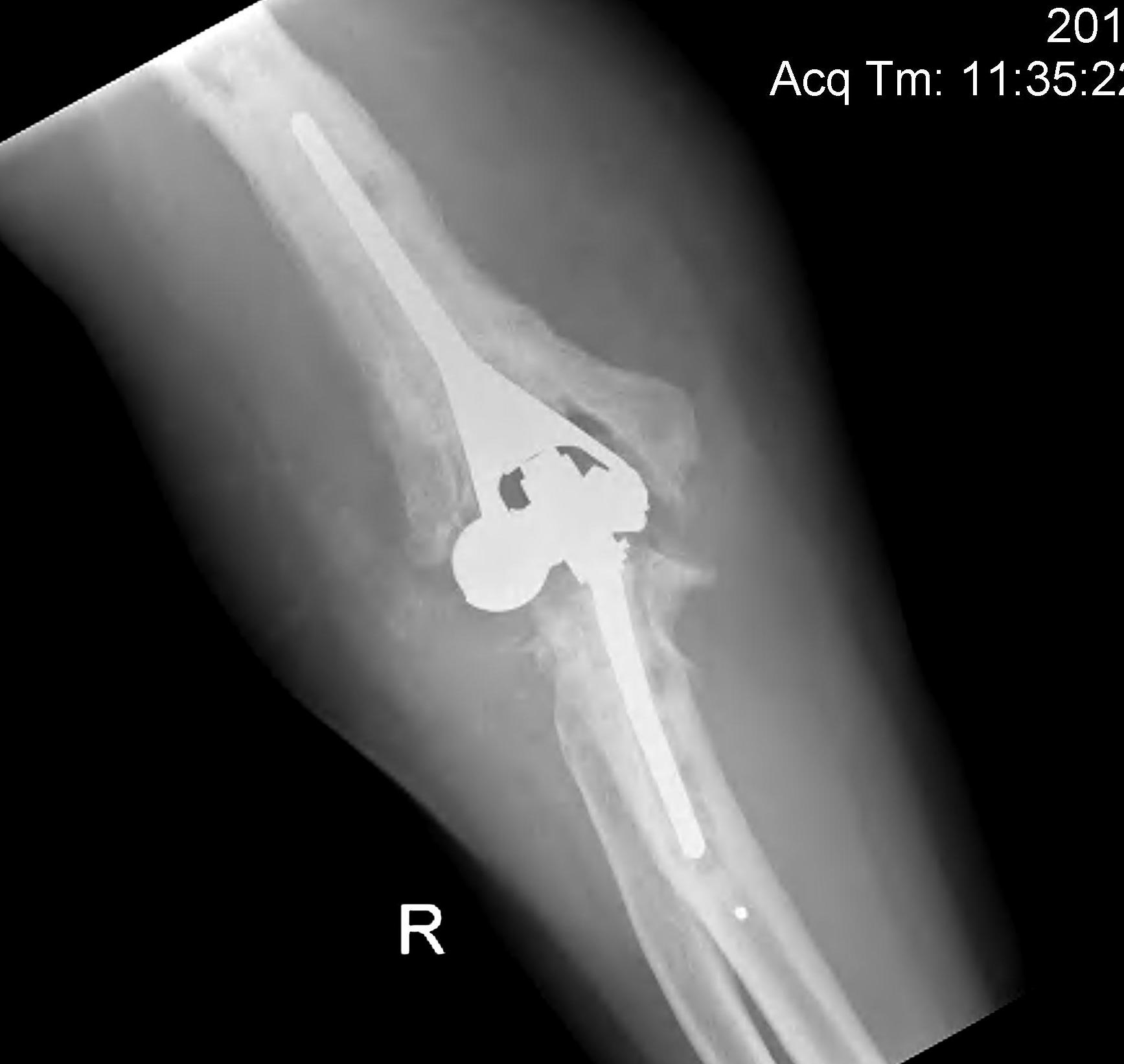 Total Elbow Replacement Infection